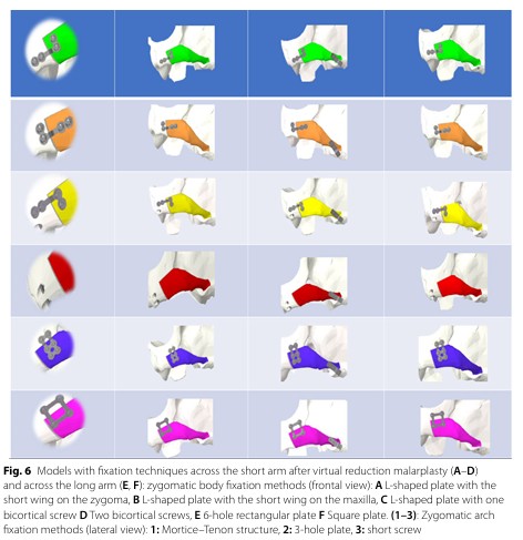 [Paper Review] What Matters More in Zygoma Reduction Than Double or Triple Fixation image 8