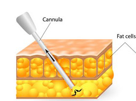 Q&A on Facelift Surgery (2): How Liposuction and AccuSculpt Affect the SMAS image 1