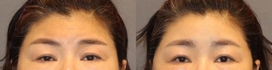 Endoscopic Forehead Lift Swelling and Recovery Time: Looking at It with Before-and-After Photos image 3