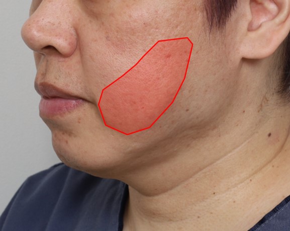 Amazing Changes Achieved with Contouring Facelift: A Facelift Technique That Even Addresses Asymmetry image 4