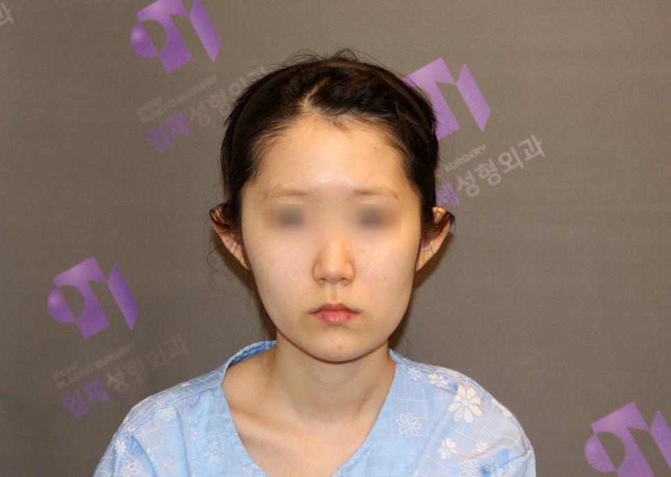 사각턱수술, 피질절골과 외측피질쉐이빙의 차이 관련 이미지 7