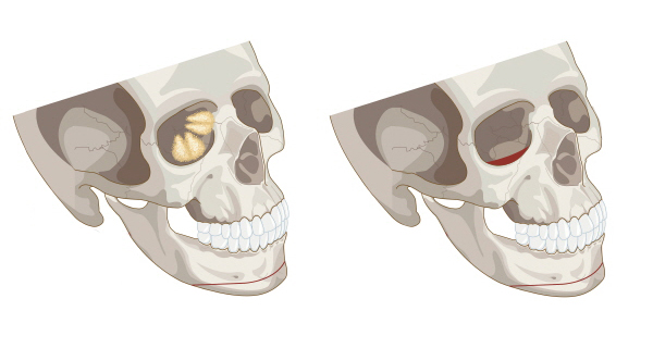 What Is the Best Way to Correct Deep-Set Eyes? image 1