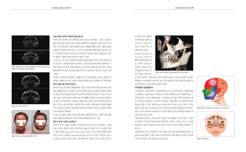 The Story After Cheek Dimple Correction image 2
