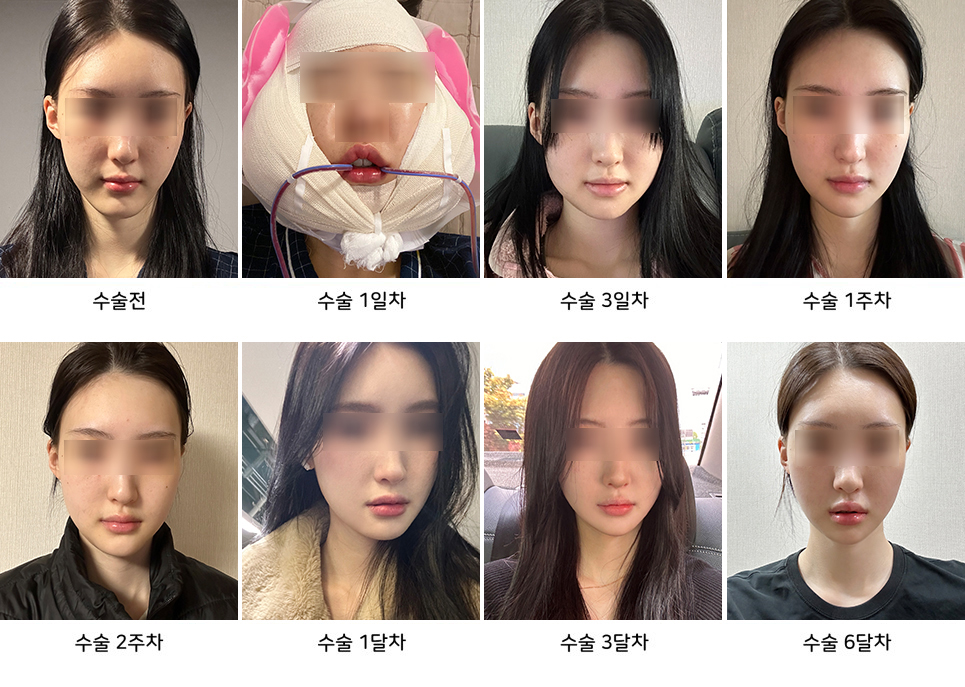 What uncomfortable symptoms can occur after chin surgery? image 1