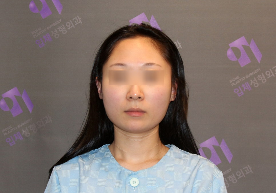 안면윤곽 볼처짐 원인은 무엇인가요? (솔직한 생각) 관련 이미지 1