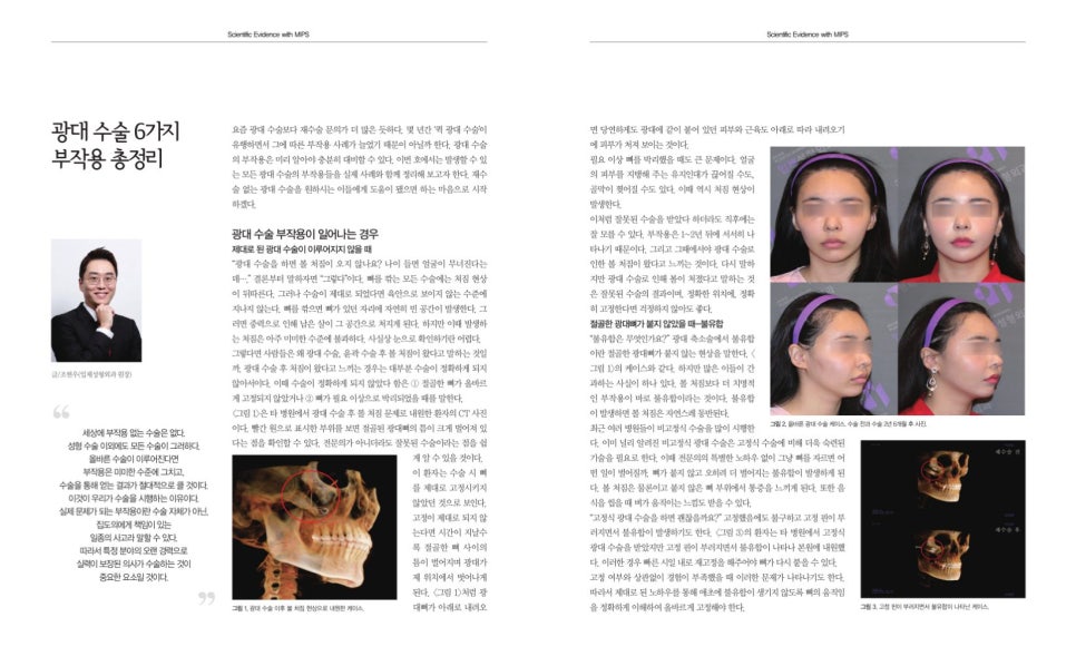 The Story After Cheek Dimple Correction image 1