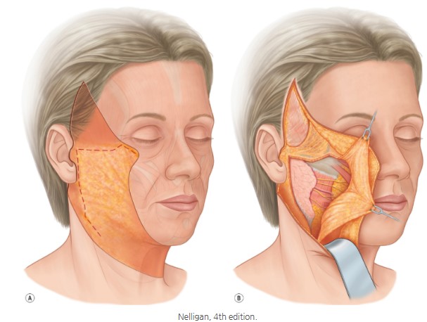 Facelift Q&A (1): The Truth and Myth of the SMAS Fascia image 1