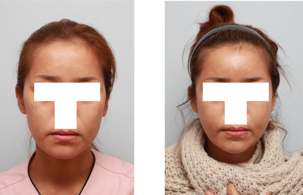 Cheek Sagging? Nonunion? Hollow Cheeks? A Complete Guide to 6 Side Effects of Zygoma Surgery image 9