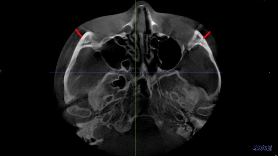 Male Cheekbone Reduction Surgery: Looking at Real Cases of Facial Contouring Surgery image 3