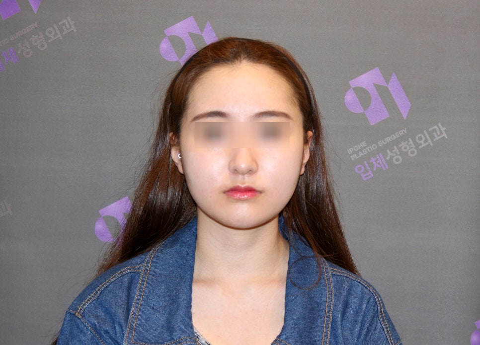 광대축소술 관련 이미지 7