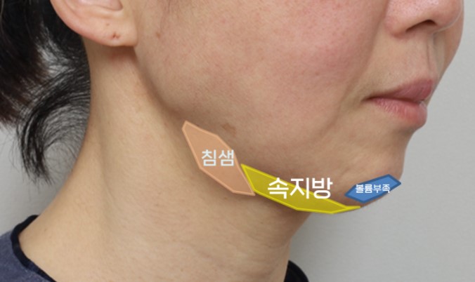 40대 안면거상 케이스 분석 및 수술 결과 관련 이미지 4