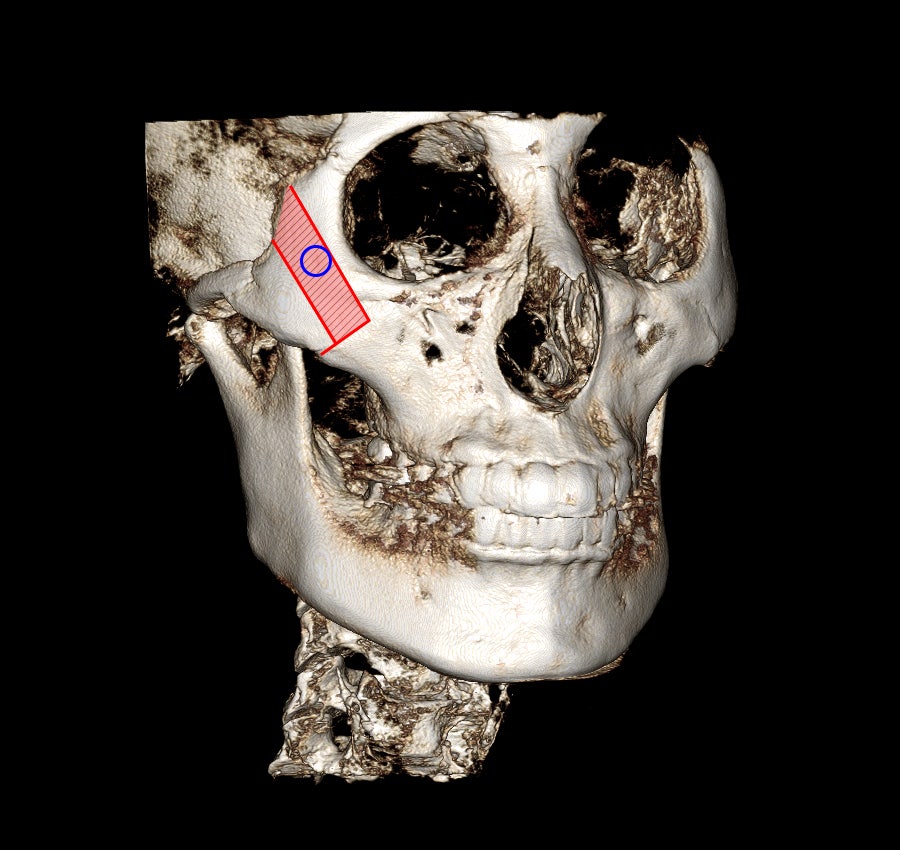 What Side Effects Can Occur Due to Excessive Reduction in Facial Contouring Surgery? image 1
