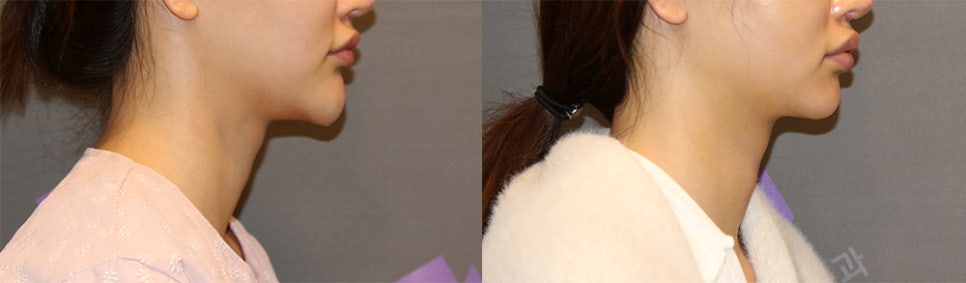 A Complication Called Chin Surgery Side Effects image 4