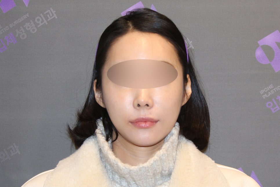 Lateral Cheekbone Reduction Surgery Review: Looking at Real Cases image 4