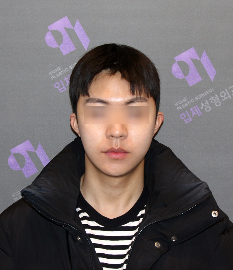 광대뼈 비대칭, 광대축소술로 교정할 수 있을까요? 관련 이미지 5