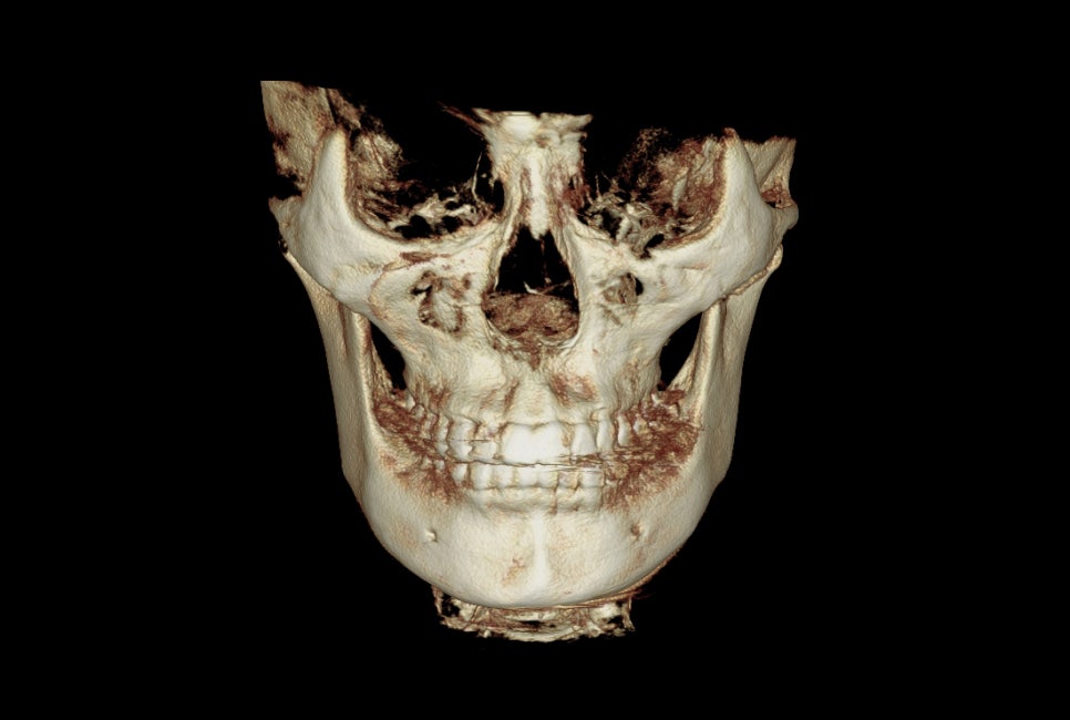 Square Jaw Surgery: The Difference Between Cortical Osteotomy and Lateral Cortical Shaving image 8