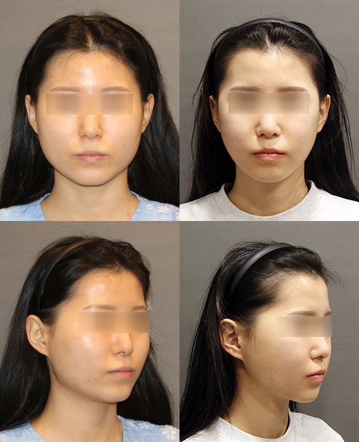 V-Line Square Jaw Surgery Is Good for the Front View Effect image 13