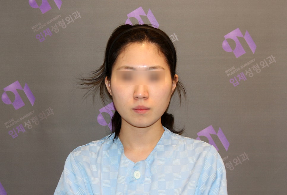 How Much Effect Does 230-Degree Three-Dimensional Zygomatic Reduction Have? image 11