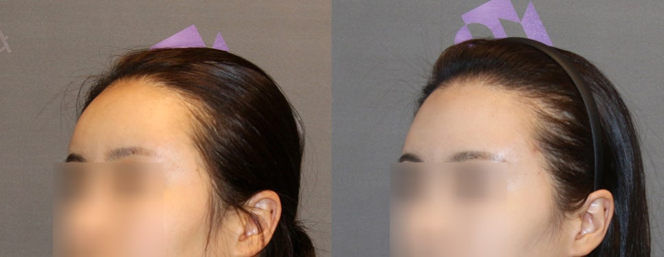 이마지방이식 제거 할 수 있을까요? 관련 이미지 6