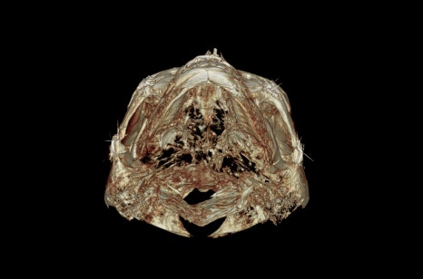 How Much Effect Does 230-Degree Zygoma Reduction Surgery Have? image 9