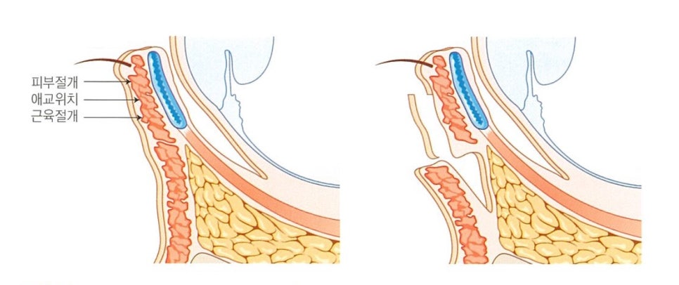 눈밑지방재배치와 하안검 수술이 어떻게 다른가요? 관련 이미지 17
