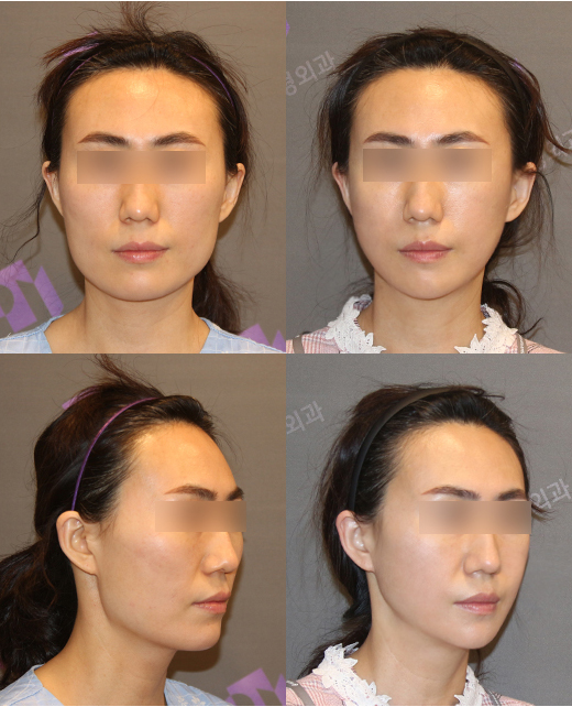 Should We Believe Every “Rumor” on Plastic Surgery Complication Cafes? image 1
