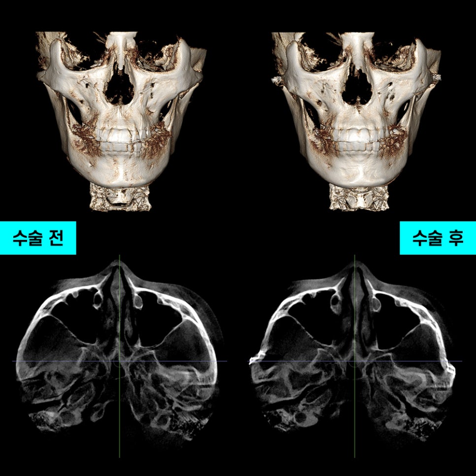 Zygoma Reduction Surgery: the Effectiveness and Selection Criteria of 230-Degree Zygoma vs. 3D Zygoma Surgery image 9