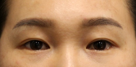 중년눈성형, 눈꺼풀 처짐은 어떻게 해결해야 할까요? 관련 이미지 9