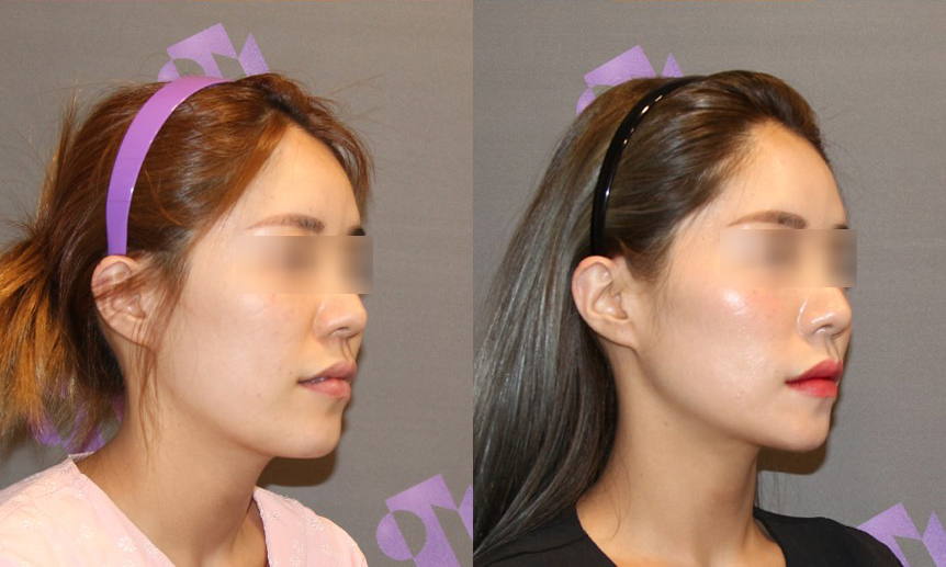 Side Effects That May Occur After Contouring Surgery and the Appropriate Solutions image 4