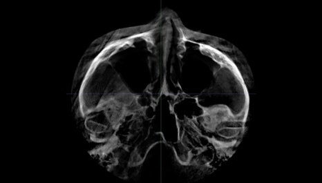 A Complete Summary of 6 Complications After Cheekbone Surgery: Sinusitis, Recurrence, Hollow Cheeks, and Sagging Cheeks image 8