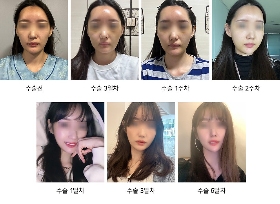 How to Reduce Swelling Quickly After Facial Contouring Surgery - Explained by a Plastic Surgeon image 4