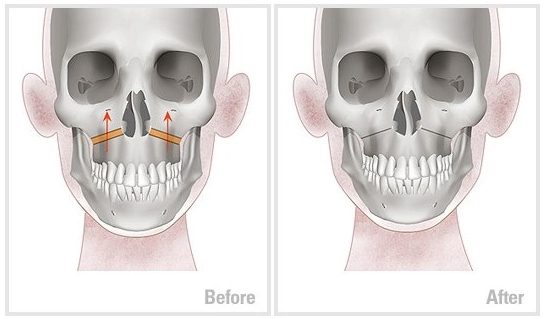 Which Surgery Do I Need: Contouring Surgery or Double-Jaw Surgery? image 18