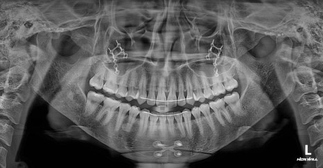 What Side Effects Can Occur Due to Excessive Bone Resection in Facial Contouring Surgery? image 8