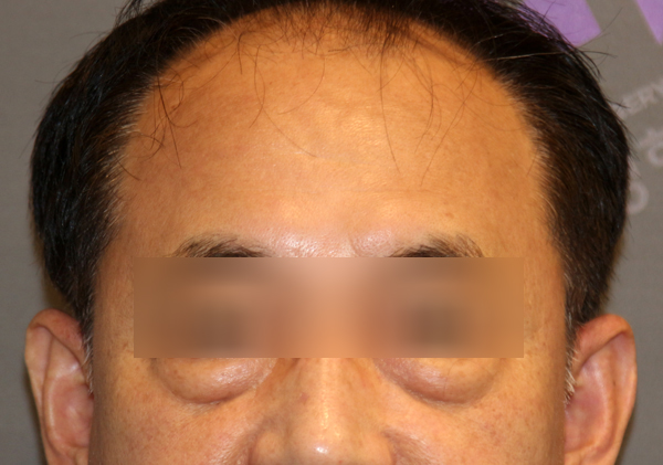 눈밑지방재배치와 하안검 수술이 어떻게 다른가요? 관련 이미지 15