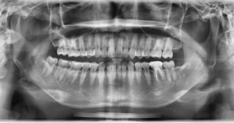 Jaw Contour Surgery: Why Is Revision Surgery Performed? image 3