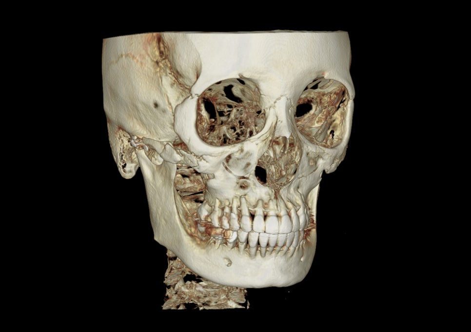 Are There Cases Where Pin Removal Is Difficult After Double Jaw or Contouring Surgery? image 3