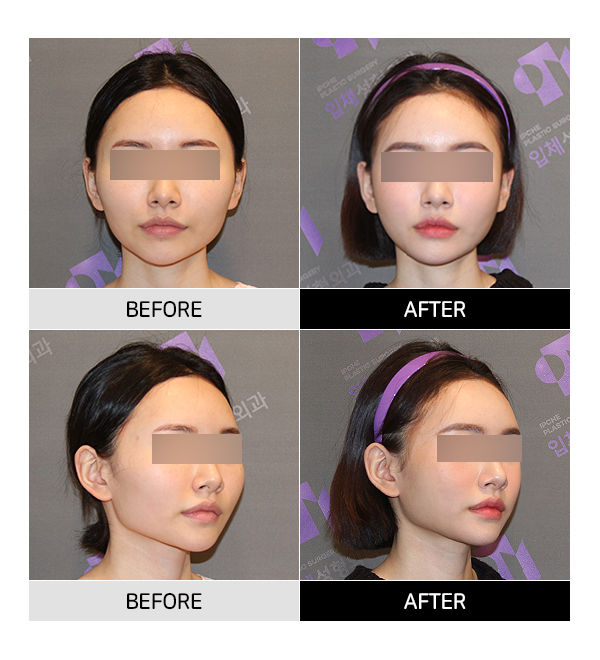 Why Are There So Many Methods for Cheekbone Surgery? A Look at Osteotomy Methods image 12