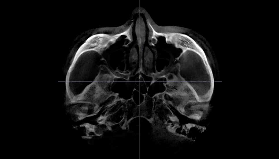 Why Is Male Cheekbone Reduction Different from Female Cheekbone Reduction? image 7