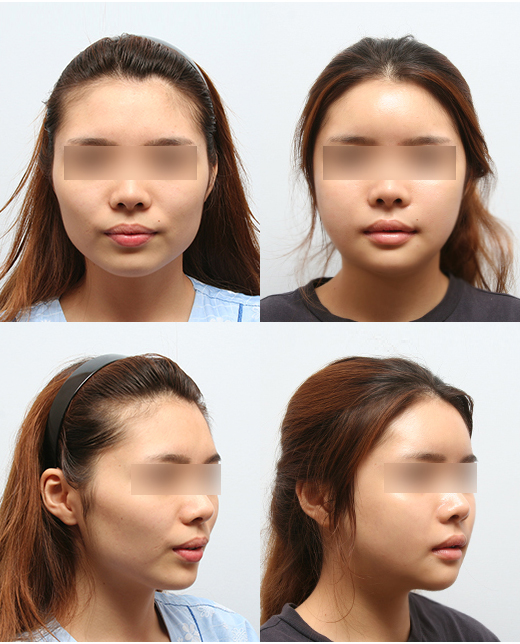 땅콩형 얼굴은 어떻게 개선할 수 있을까요? 관련 이미지 5
