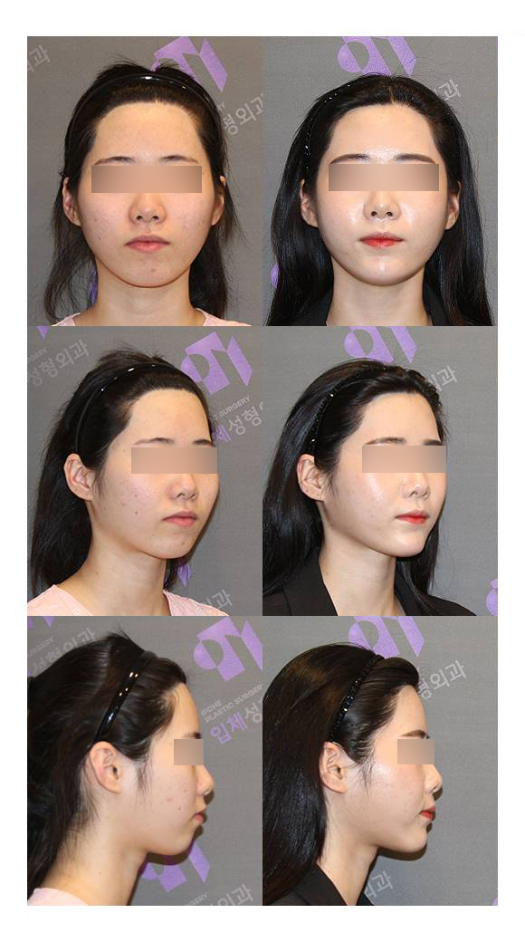 [Chin Correction Surgery] Implants and Genioplasty: Real Patient Cases and How They Work image 4