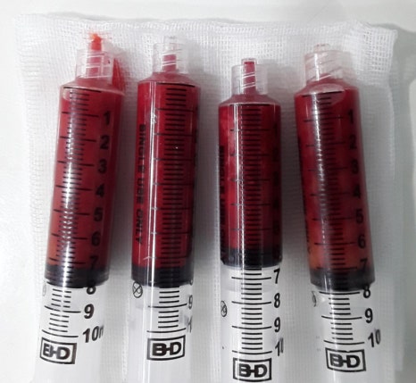 Forehead Fat Grafting Side Effects: Is There a Way to Remove Excess Fat? image 1