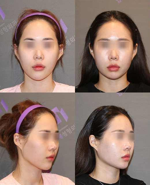 Will Zygoma Reduction Surgery Make Your Face Look Longer? - Explained by a Board-Certified Plastic Surgeon image 2