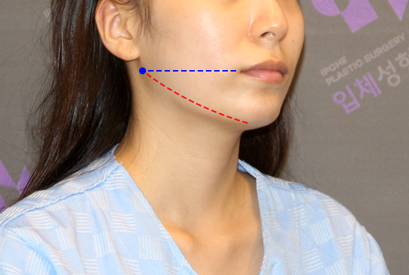 If There Is No Jaw Angle Below the Ear, Is It a Dog Jaw? What Is a Dog Jaw? image 8