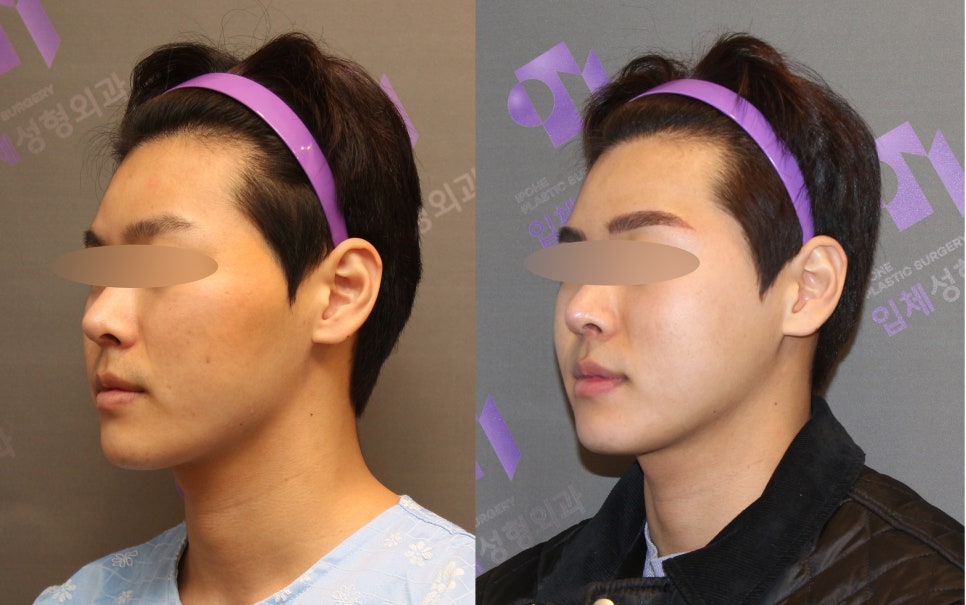 Male Cheekbone Reduction Surgery, Explained with Before-and-After Photos of Facial Contouring Surgery. image 6