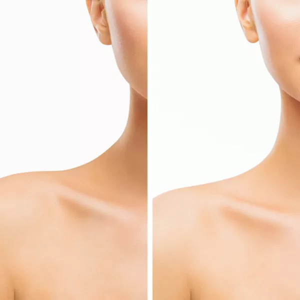 The Botox Effects We Know Aren’t All There Is image 2