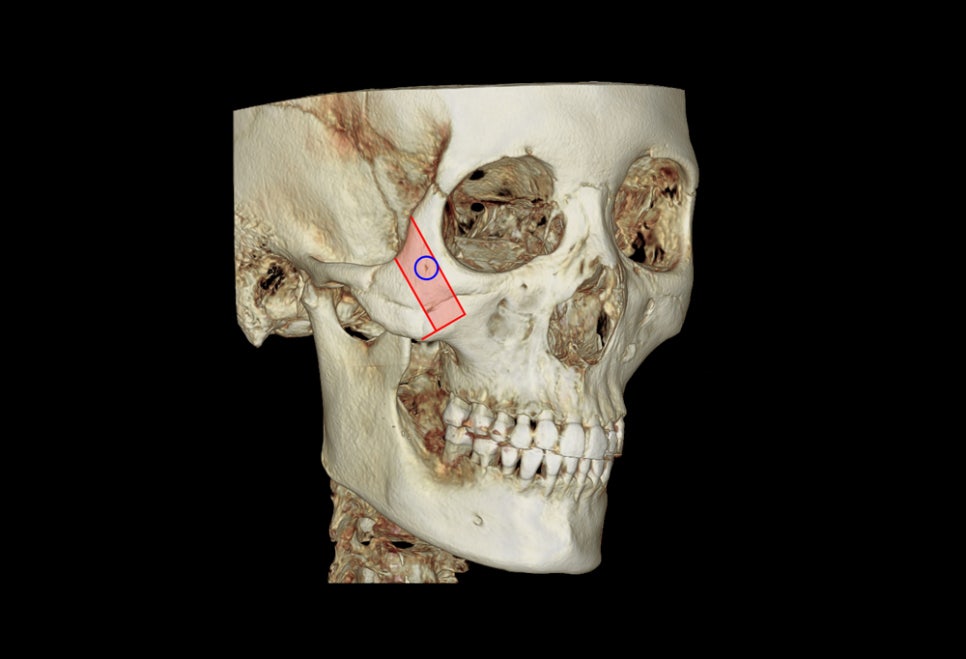 What Side Effects Can Occur Due to Excessive Bone Resection in Facial Contouring Surgery? image 1