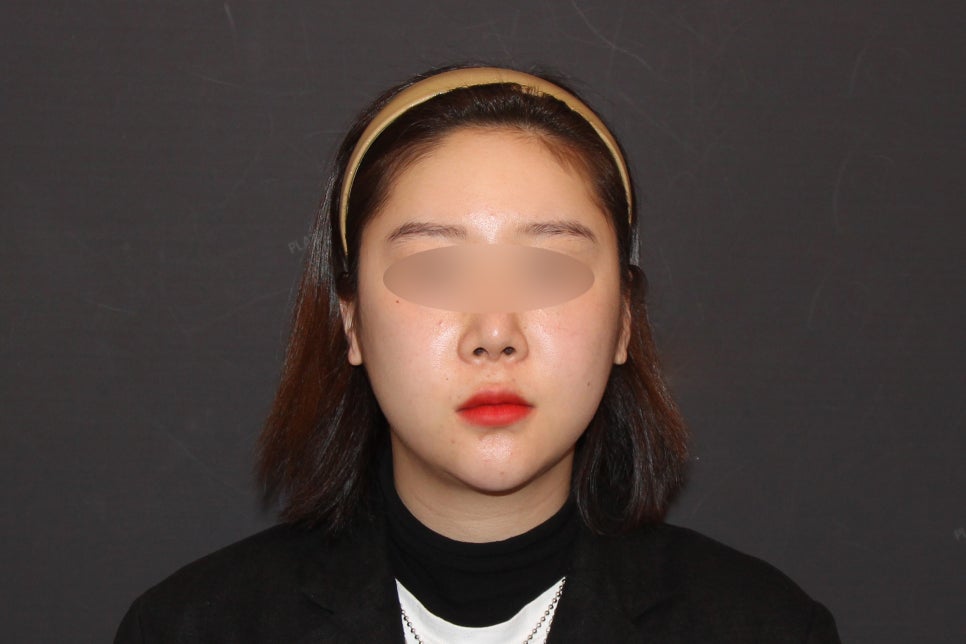 Facial Contouring Swelling, When Can I Go Back to Work? - A Specialist Explains Directly [입체성형외과] image 3