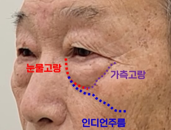 The Evolution of Fourth-Generation Lower Blepharoplasty - Midface Lift (Cheek Lift) and Apple Cheeks image 1
