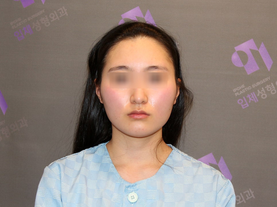 광대축소술 관련 이미지 6