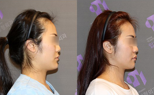 주걱턱 교정은 어떤 수술이 좋을까요? 턱끝후진술의 한계와 실제 결과 관련 이미지 3